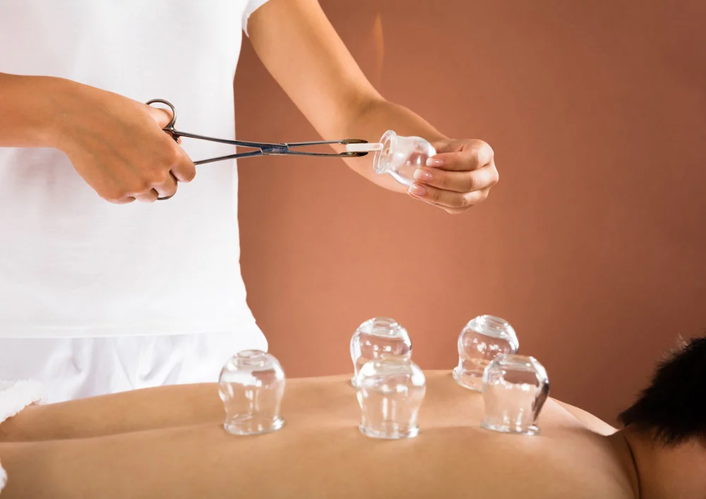 Cupping Physical Therapy Huntington New York USA